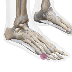 足の指の骨折