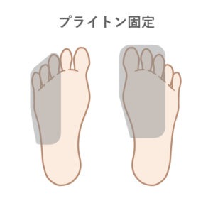 足の指の骨折の治療